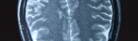 Research Summary: Grouping Genetic Differences of Autism Spectrum Disorder with Brain Imaging